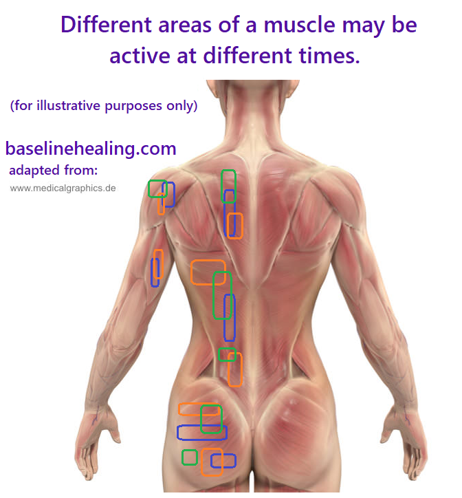human figure showing muscles of back and buttocks. Various small areas of muscle are highlighted in different colours to illustrate how different areas of a muscle might be working at different times, that it is not all or nothing when a muscle works some fibres might be active while others are resting or spasming. Myalgia of imbalance when the wrong areas of muscle are activated instead of the main muscles of movement.